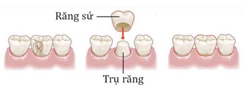 kỹ thuật bọc răng sứ
