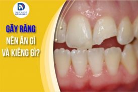 Gãy răng nên ăn gì và kiêng gì?