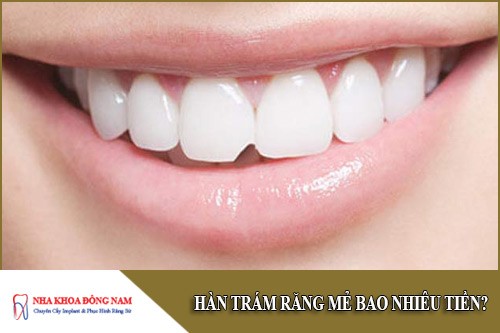 Hàn trám răng mẻ mất bao nhiêu tiền?