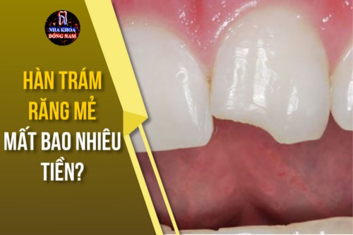Hàn trám răng mẻ mất bao nhiêu tiền?