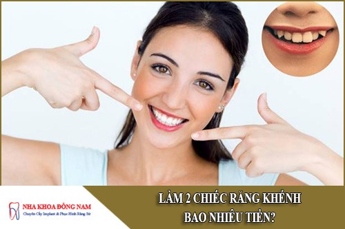 Làm 2 chiếc răng khểnh bao nhiêu tiền
