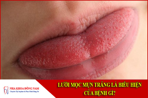 Lưỡi mọc mụn trắng là biểu hiện của bệnh gì?