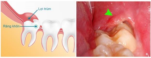 viêm lợi trùm răng khôn
