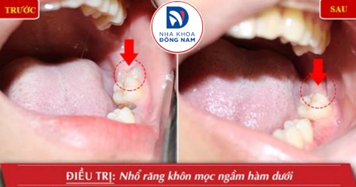 nhổ răng khôn mọc ngầm hàm dưới