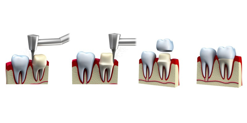 Mô phỏng kỹ thuật bọc răng sứ thẩm mỹ