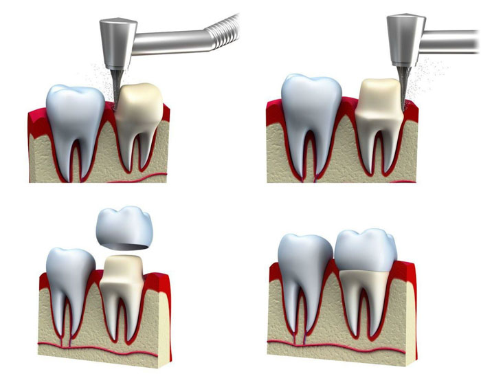 Mô phỏng kỹ thuật bọc răng sứ thẩm mỹ