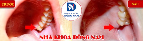 nhổ răng khôn hàm trên