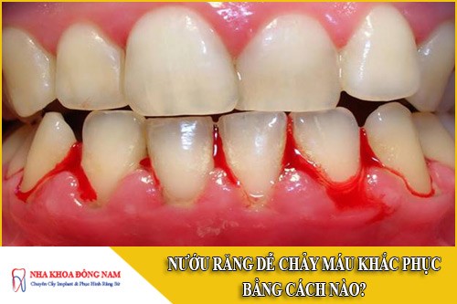 Nướu răng dễ chảy máu khắc phục thế nào?