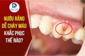 Nướu răng dễ chảy máu khắc phục thế nào?