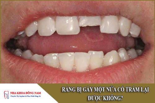 Răng bị gãy một nửa có trám lại được không?