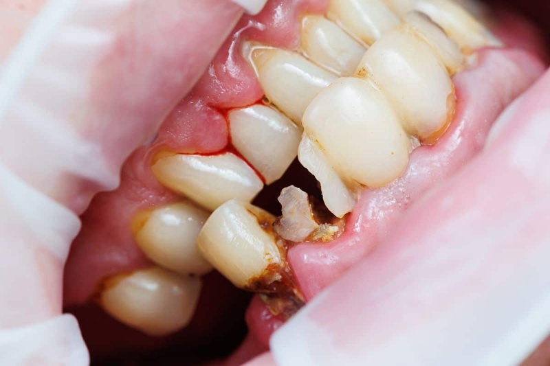 Răng gãy có thể ảnh hưởng trực tiếp đến các răng xung quanh