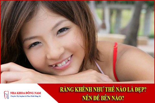 Răng khểnh thế nào là đẹp? Nên để bên nào?