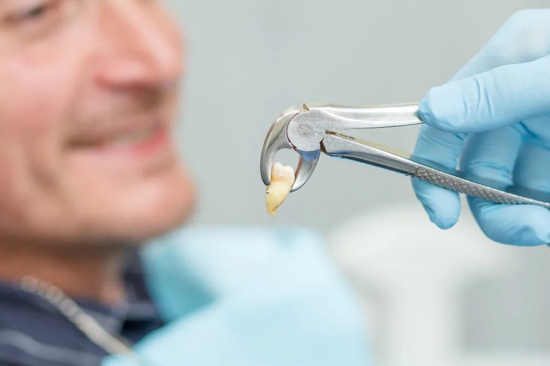 Răng khôn bị mẻ nên được nhổ bỏ sớm