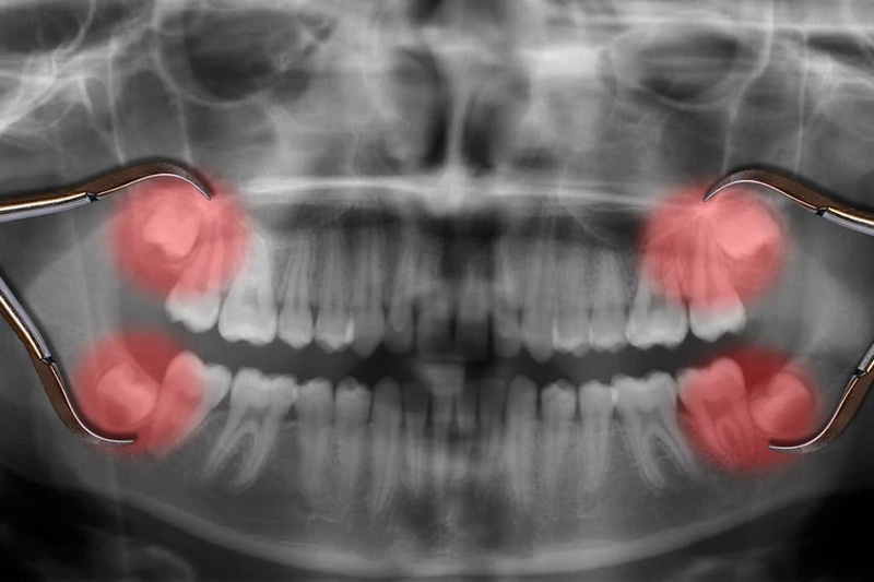 Răng khôn là răng nằm ở vị trí số 8 trên cung hàm