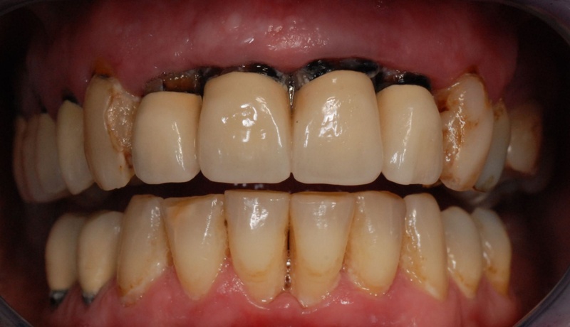 Răng sứ hở giắt thức ăn gây hôi miệng