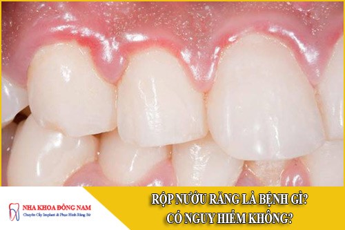 Rộp nướu răng là bệnh gì? Có nguy hiểm không?