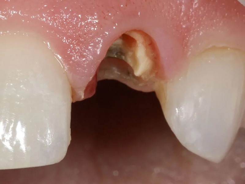 Sâu răng không điều trị có thể gãy lớn chỉ còn chân răng