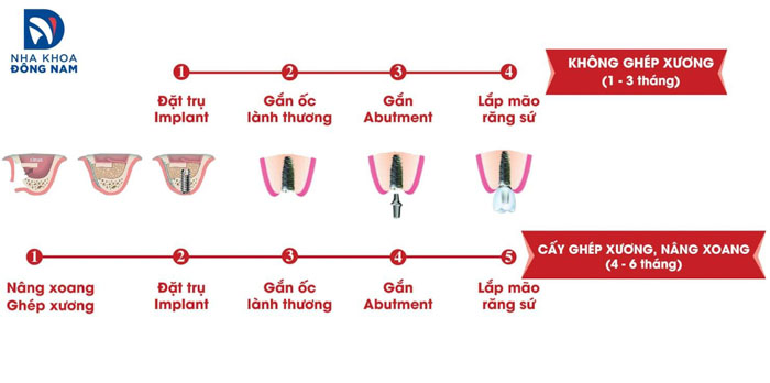 Thời gian trồng răng Implant