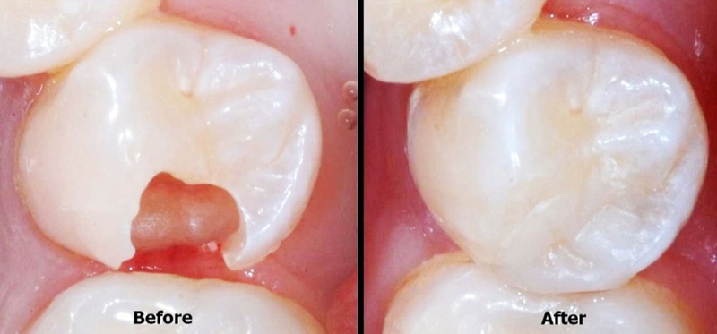 Trám răng gãy, mẻ nhỏ