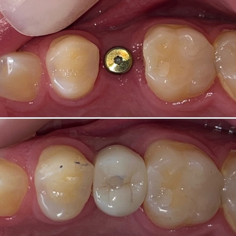 Trồng răng Implant phục hình răng cấm gãy, mất răng
