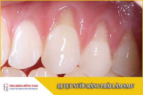 Bị tụt nướu răng phải làm sao