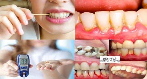 Nguyên nhân gây bệnh viêm quanh răng