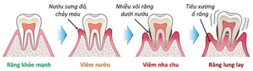 diễn biến của bệnh nha chu