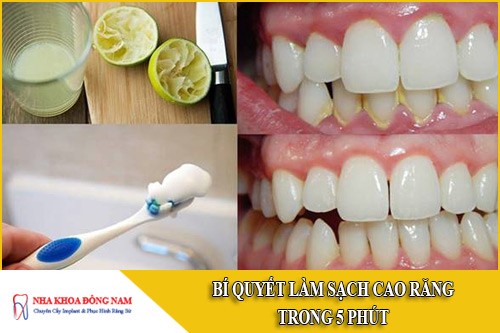 Bí quyết làm sạch cao răng trong 5 phút