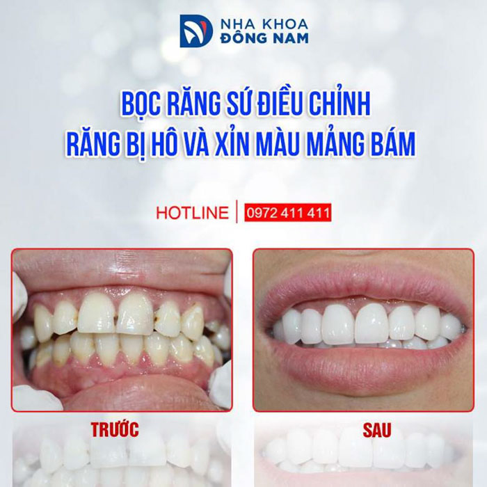 Bọc răng sứ khắc phục răng hô nhẹ