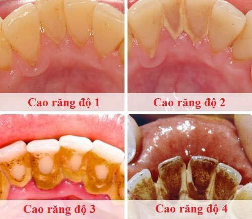 Các cấp độ của vôi răng