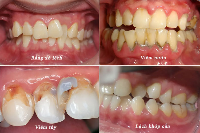 Cách chỉnh răng mọc lệch tại nhà tiềm ẩn nhiều biến chứng nguy hiểm