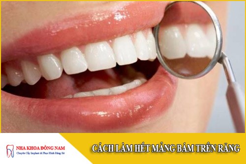 Cách làm hết mảng bám trên răng trong vòng 30 phút
