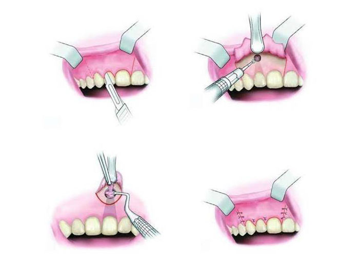 Cắt chóp răng là phương pháp loại bỏ phần chóp răng bị viêm nhiễm