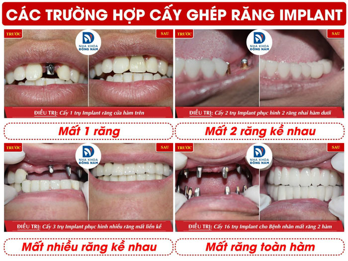 Cấy ghép Implant phục hình hiệu quả cho mọi tình trạng mất răng