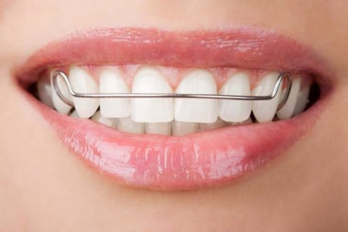 đeo hàm duy trì sau niềng răng