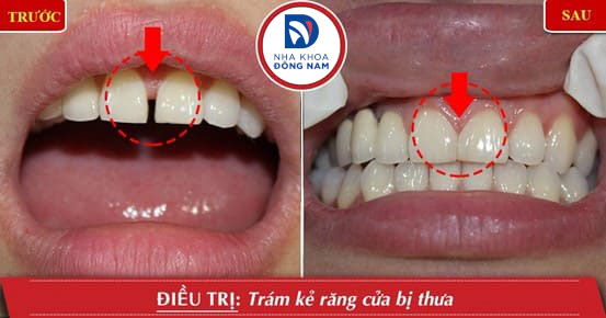 Giới thiệu về tình trạng răng cửa thưa