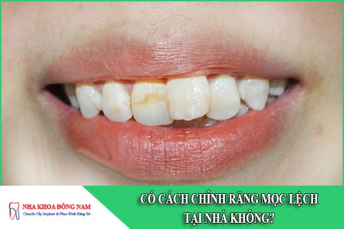 Có cách chỉnh răng mọc lệch tại nhà không?
