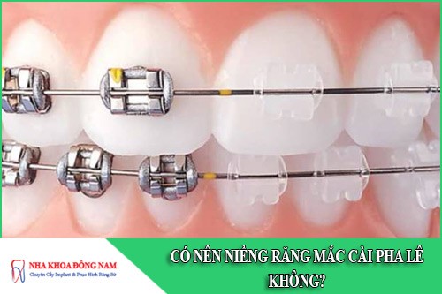 Có nên niềng răng mắc cài pha lê không?