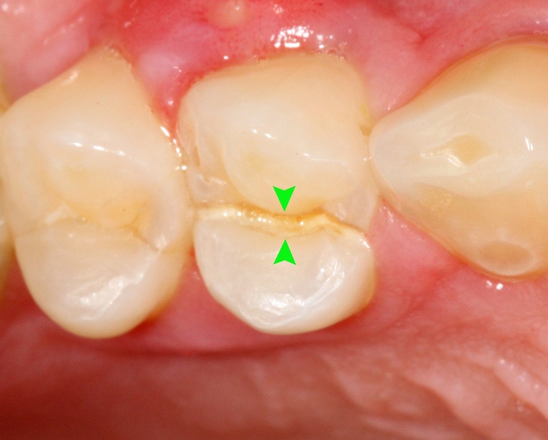 Có nhiều tình trạng răng nứt dọc khác nhau