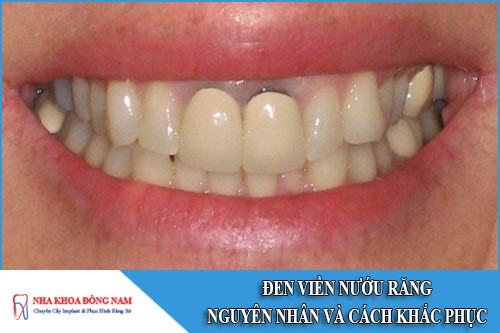 Đen viền nướu răng: Nguyên nhân và cách khắc phục