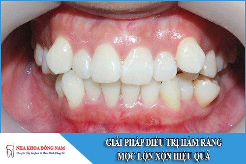 Giải pháp điều trị hàm răng mọc lộn xộn hiệu quả