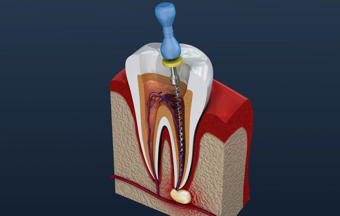 Điều trị nội nha giúp bảo tồn chiếc răng bị tổn thương