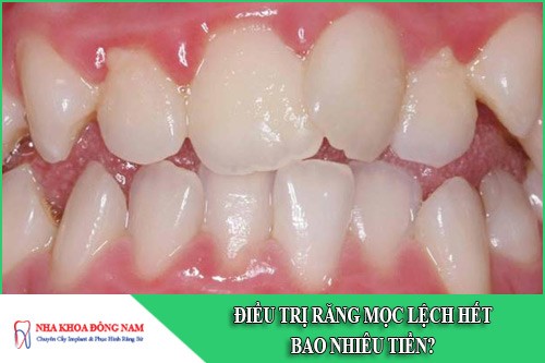 Điều trị răng mọc lệch hết bao nhiêu tiền?