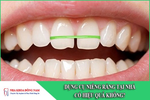 Dụng cụ niềng răng tại nhà có hiệu quả không?