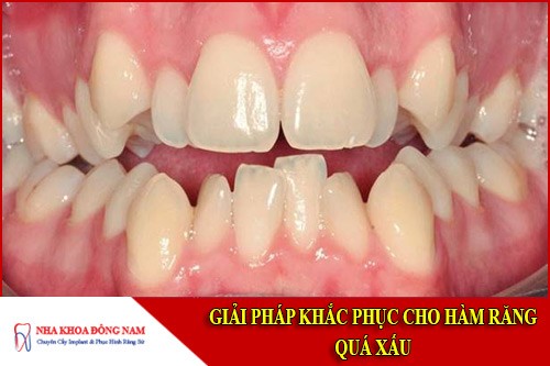 Giải pháp khắc phục cho Hàm Răng Quá Xấu