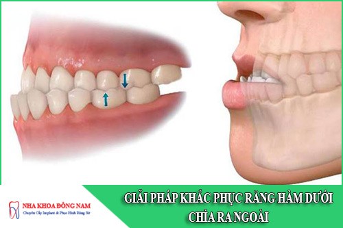 Giải pháp khắc phục hàm răng dưới chìa ra ngoài