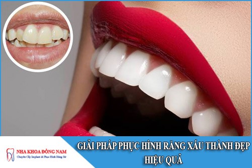 Giải pháp phục hình răng xấu thành đẹp hiệu quả