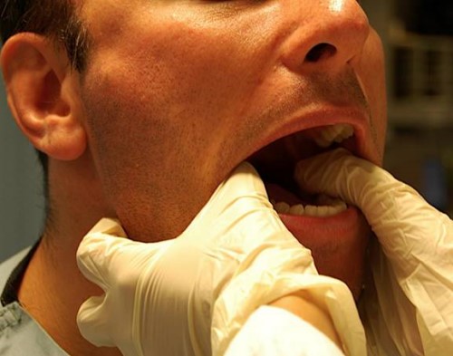 Há miệng bị đau hàm xử lý như thế nào?