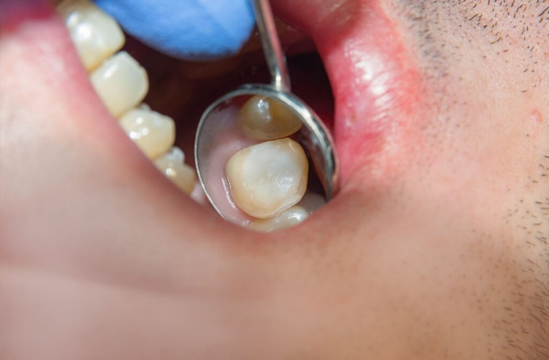 Hàn trám giúp bảo tồn răng lung lay nhẹ