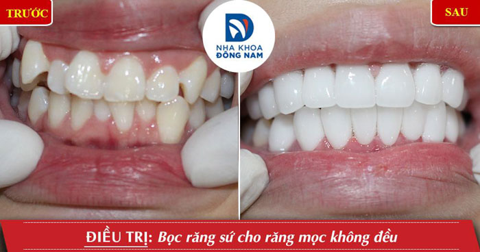 Hình ảnh thực tế bệnh nhân sau khi bọc sứ cho răng mọc không đều